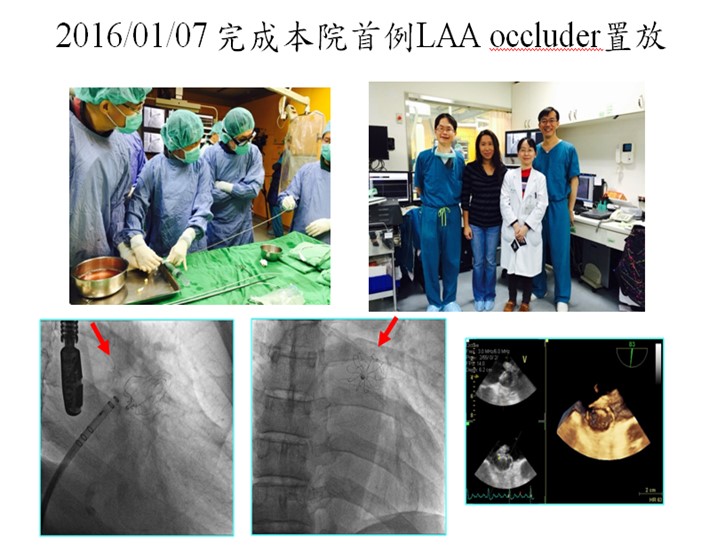 本中心完成首例左心耳關閉術。