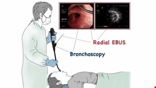Bronchoscopy Examination 支氣管鏡檢查
