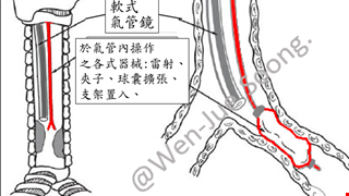 兒童氣管支架術後說明