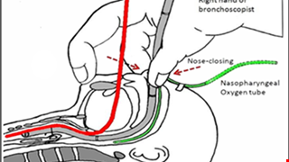 Pediatric Bronchoscopy and Treatment 兒童氣管鏡檢查及治療