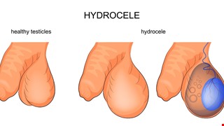 Scrotal Edema 陰囊水腫