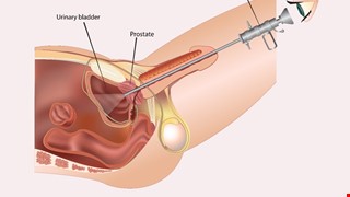 Cystoscopy Instructions 膀胱鏡檢查須知