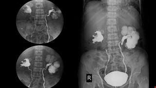 Retrogradepyelography 逆行性腎盂攝影術檢查說明
