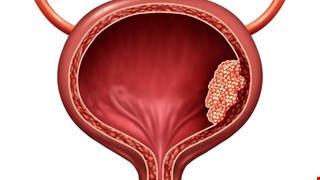Learn about Bladder Cancer 認識膀胱癌