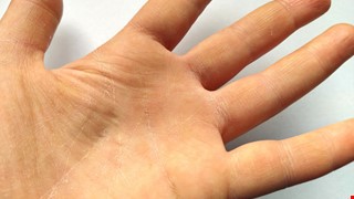 Hand Eczema 什麼是富貴手？