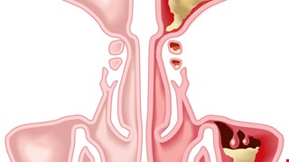 Rhinosinusitis 鼻竇炎