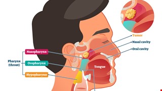 Nasopharyngeal carcinoma 鼻咽癌介紹