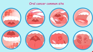Oral Cancer 了解口腔癌