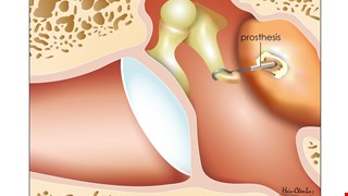 人工聽小骨手術後衛教說明