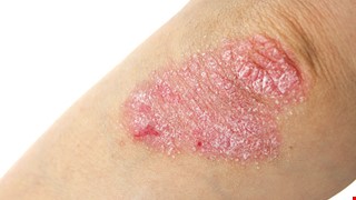 Psoriasis Prevention and health 乾癬的預防與保健