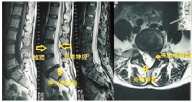 椎間盤突出