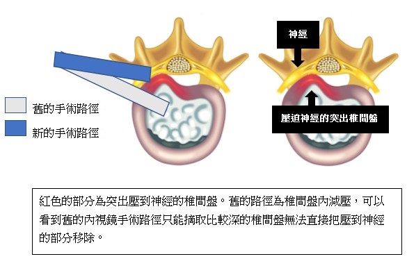 微創脊椎手術新選擇：脊椎內視鏡手術演進和介紹