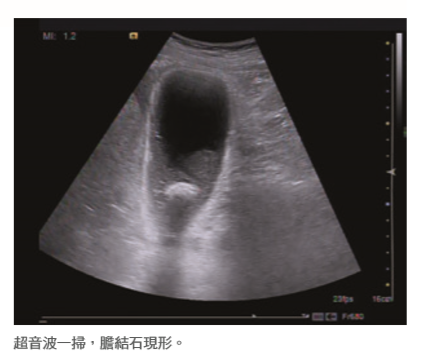 好「膽」嘜走 細說膽結石與急性膽囊炎