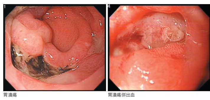 胃潰瘍