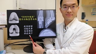 人工關節感染又化膿 「3D列印模具」術後順利回到工作崗位