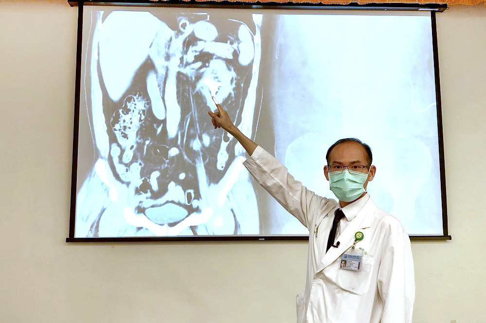 憋尿憋出鹿角狀腎結石 微創雙鏡聯合手術一次清除