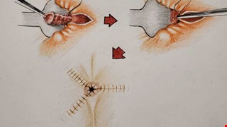 《新型雙極雷射痔瘡手術》談談原理及臨床成果