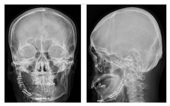 精準顱顏重建 —「電腦輔助設計3D列印」及「定位導航輔助」